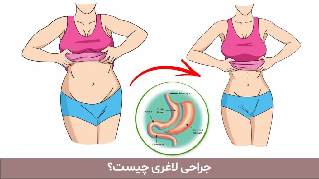 جراحی لاغری