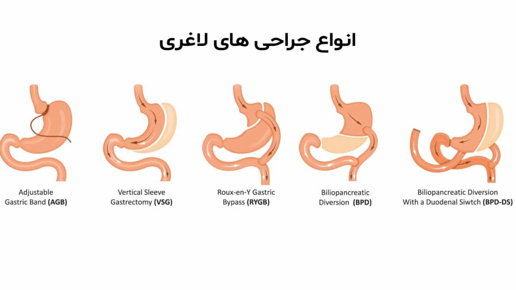 انواع جراحی های لاغری