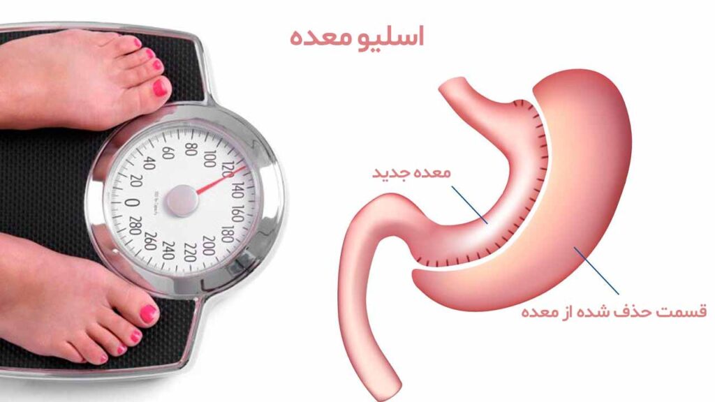  عمل اسلیو معده