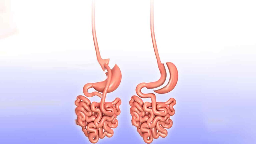 مقایسه عمل لاغری اسلیو معده و عمل لاغری بای پس