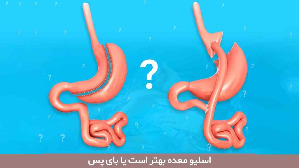 اسلیو معده بهتر است یا بای پس