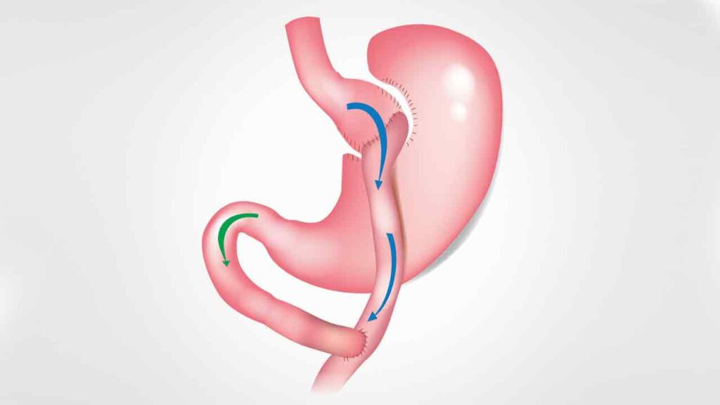 عمل جراحی بای پس معده