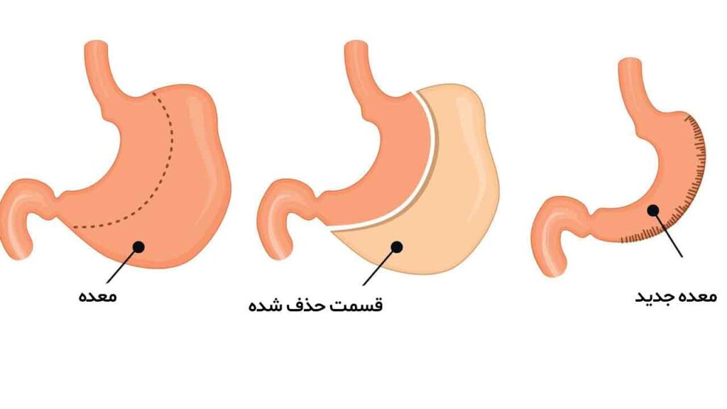 عمل اسلیو معده