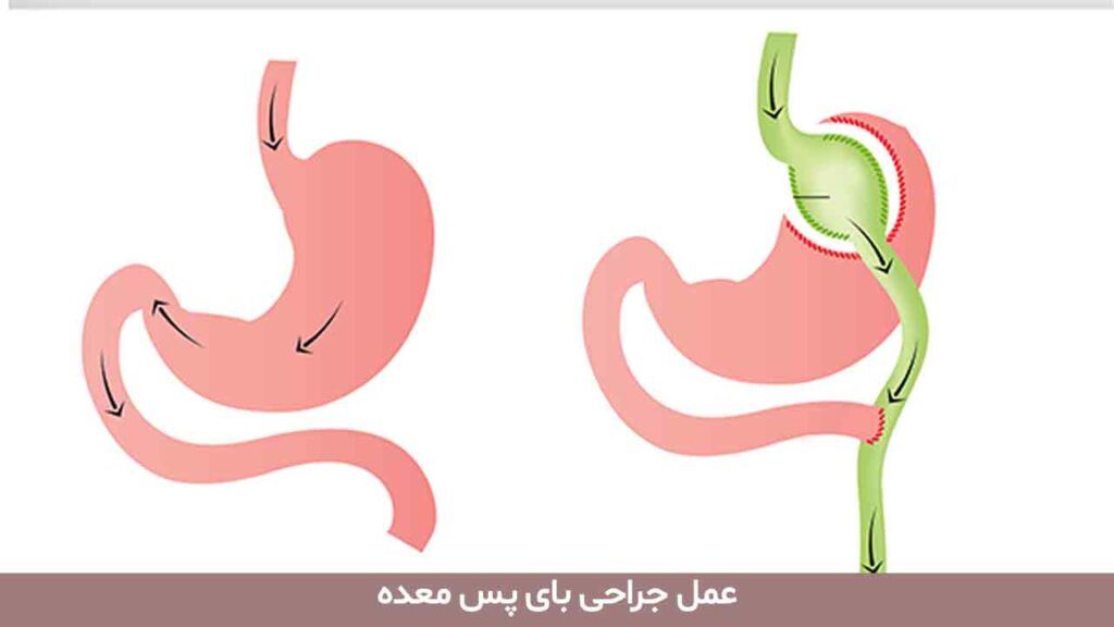 عمل جراحی بای پس معده