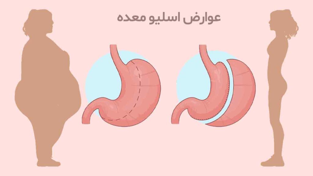 عوارض اسلیو معده