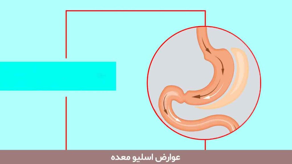 عوارض اسلیو معده