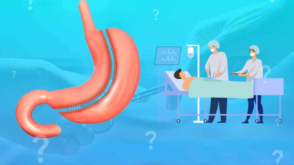 پیشگیری از بروز عوارض اسلیو معده