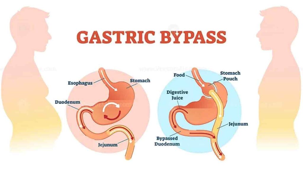 عمل بای پس معده چیست؟