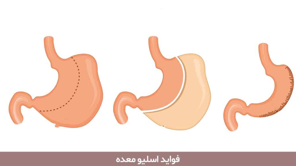 فواید اسلیو معده