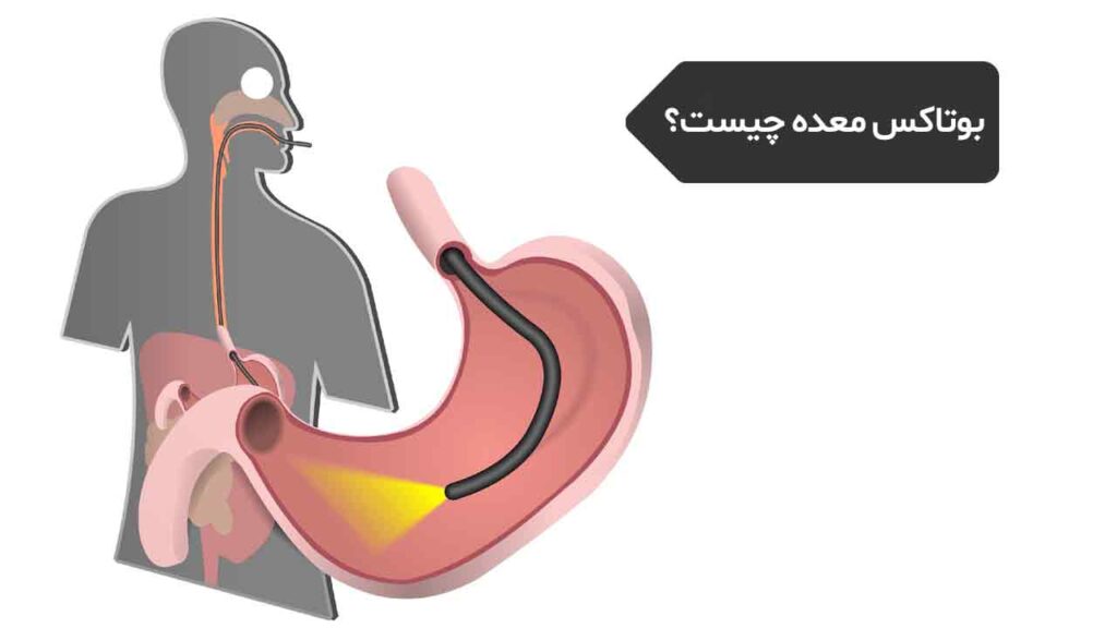 بوتاکس معده چیست؟