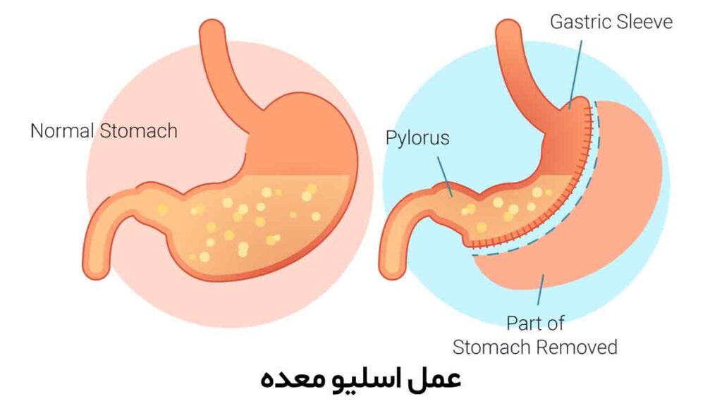 عمل اسلیو معده