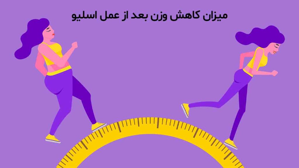 میزان کاهش وزن بعد از عمل اسلیو