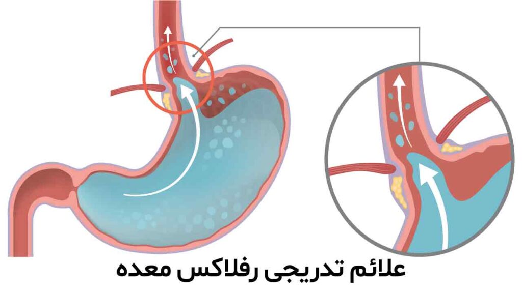 علائم تدریجی رفلاکس معده