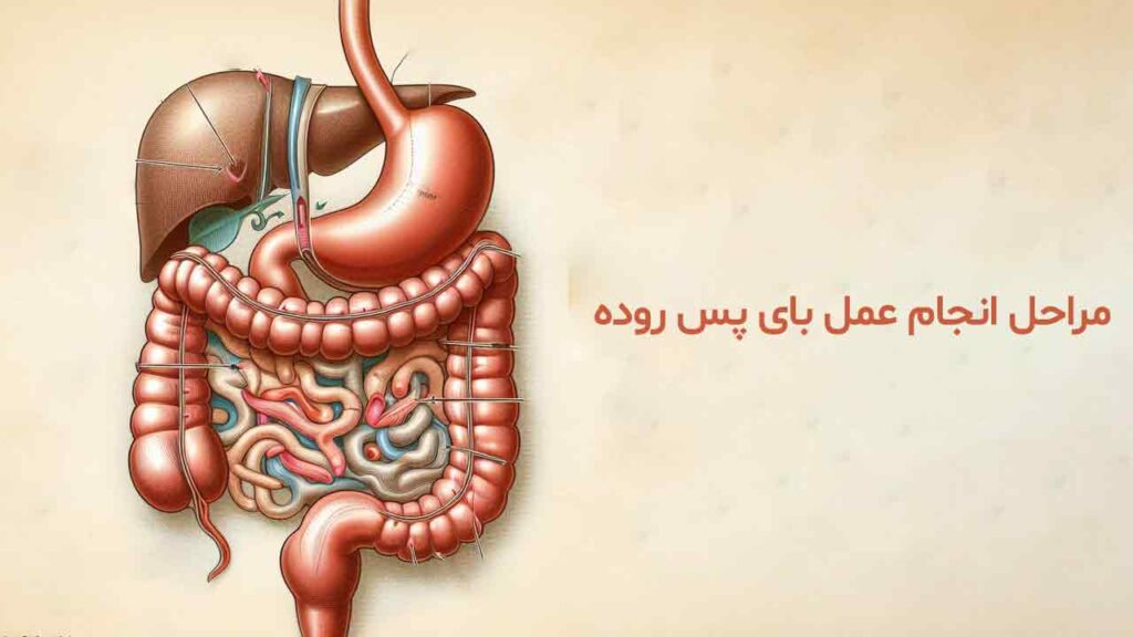 مراحل انجام عمل بای پس روده