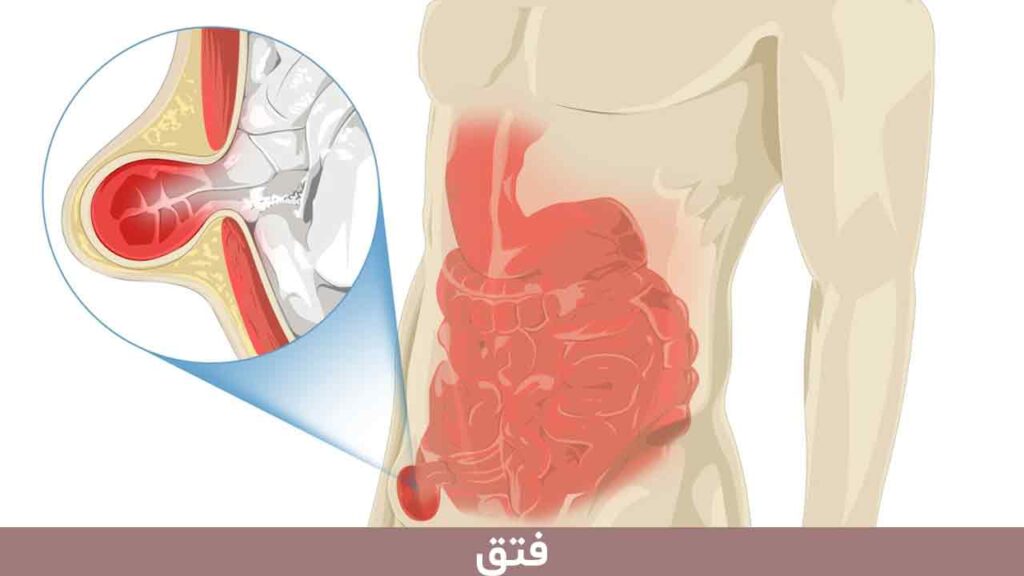 فتق یا هرنی