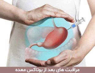 مراقبت های بعد از بوتاکس معده