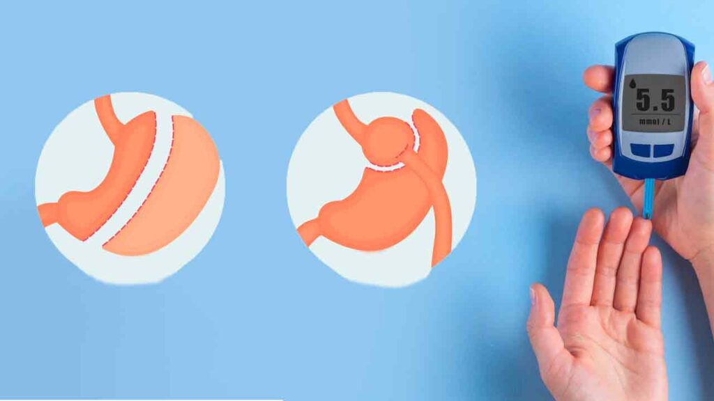 انواع جراحی لاغری برای دیابتی ها