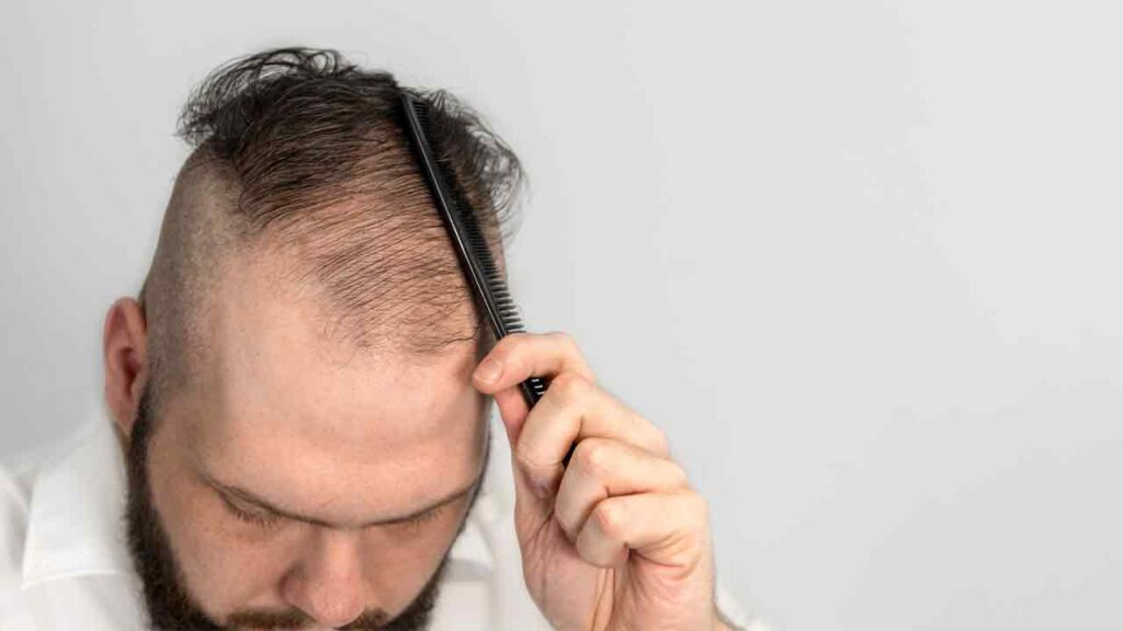 ریزش دائمی مو بعد از عمل اسلیو معده 