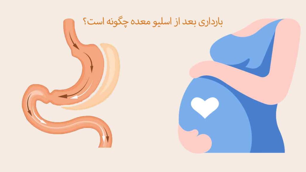 بارداری بعد از اسلیو معده چگونه است؟