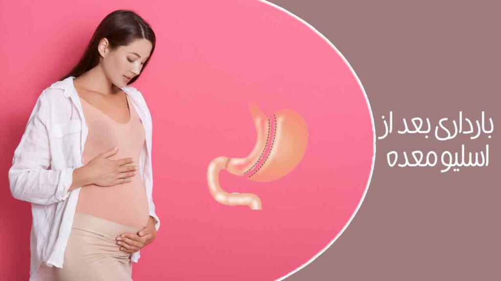 بارداری بعد از اسلیو معده