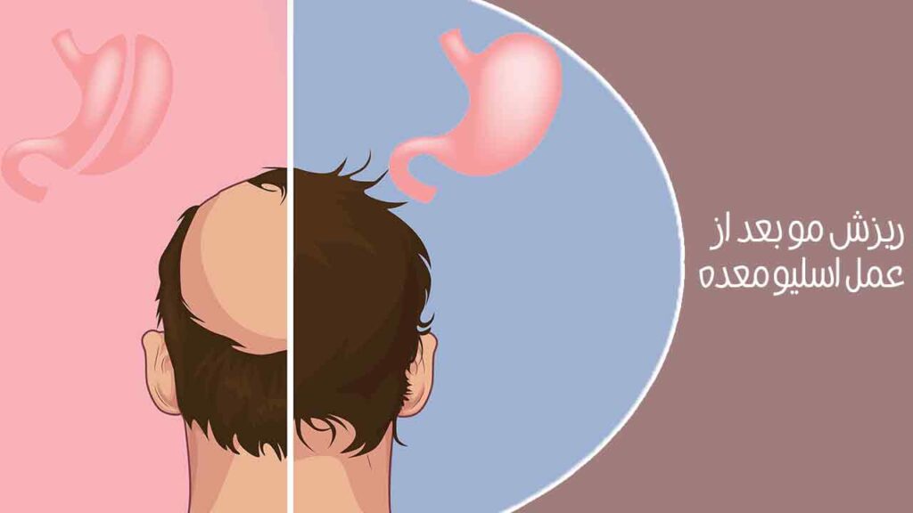 ریزش مو بعد از عمل اسلیو معده