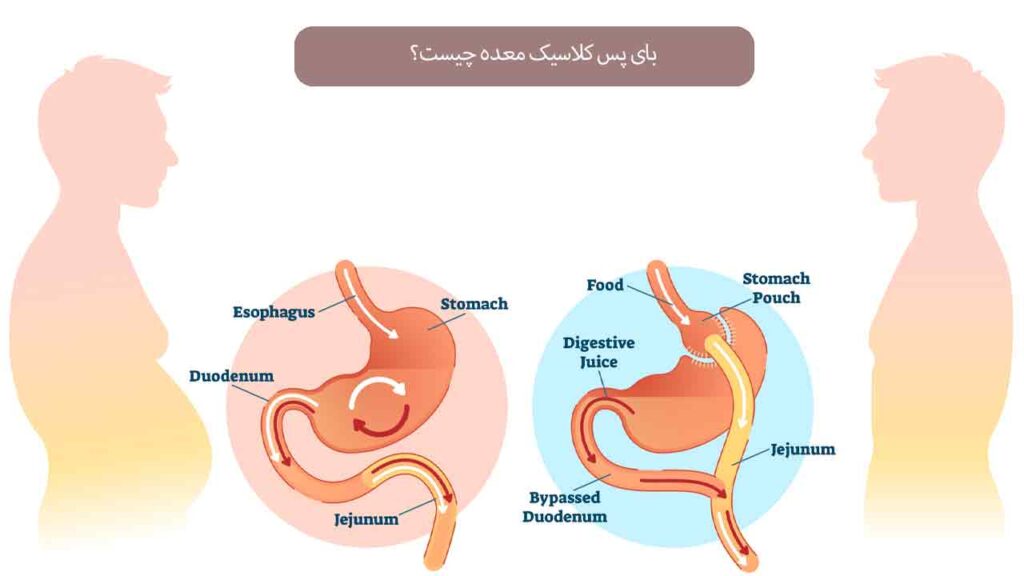 بای پس کلاسیک معده چیست؟