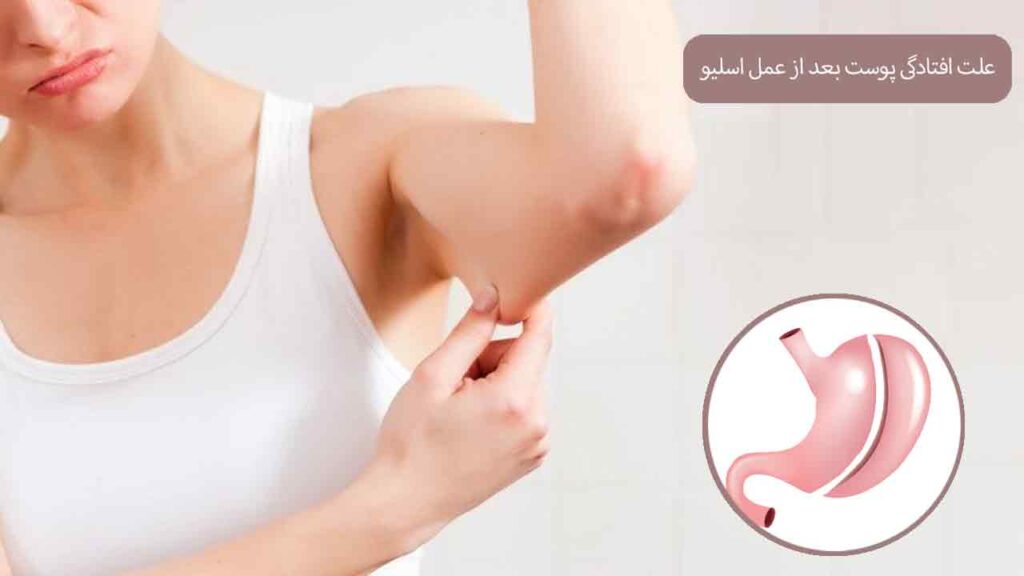 افتادگی پوست بازو بعد از اسلیو معده