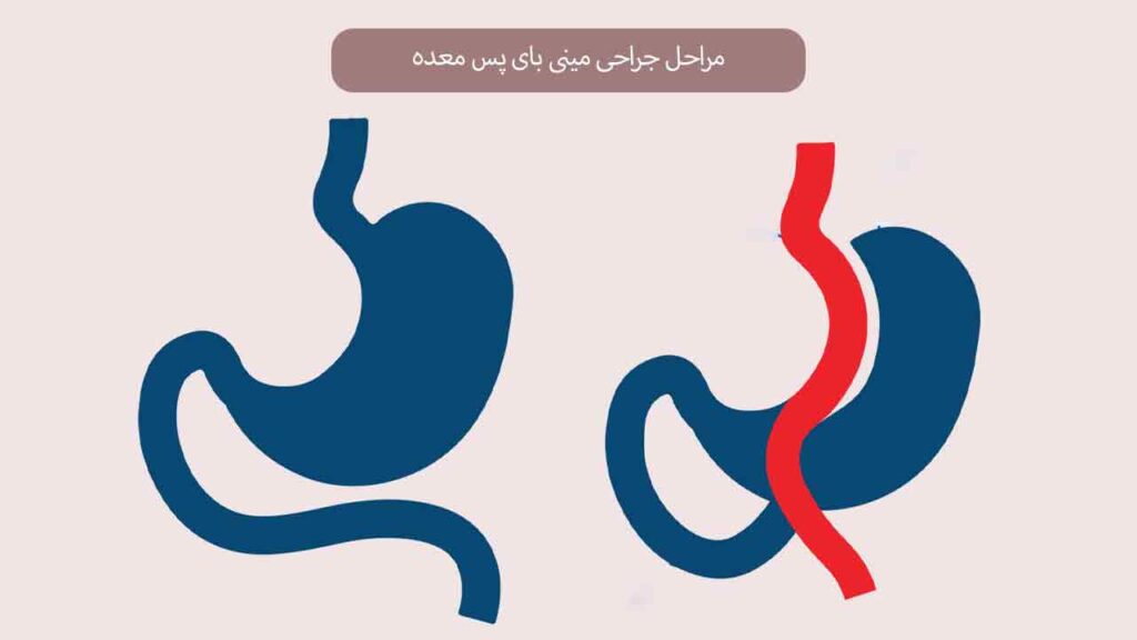 مراحل جراحی مینی بای پس معده