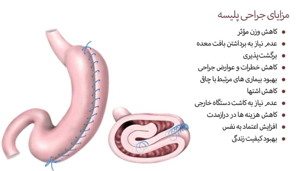 مزایای جراحی پلیسه