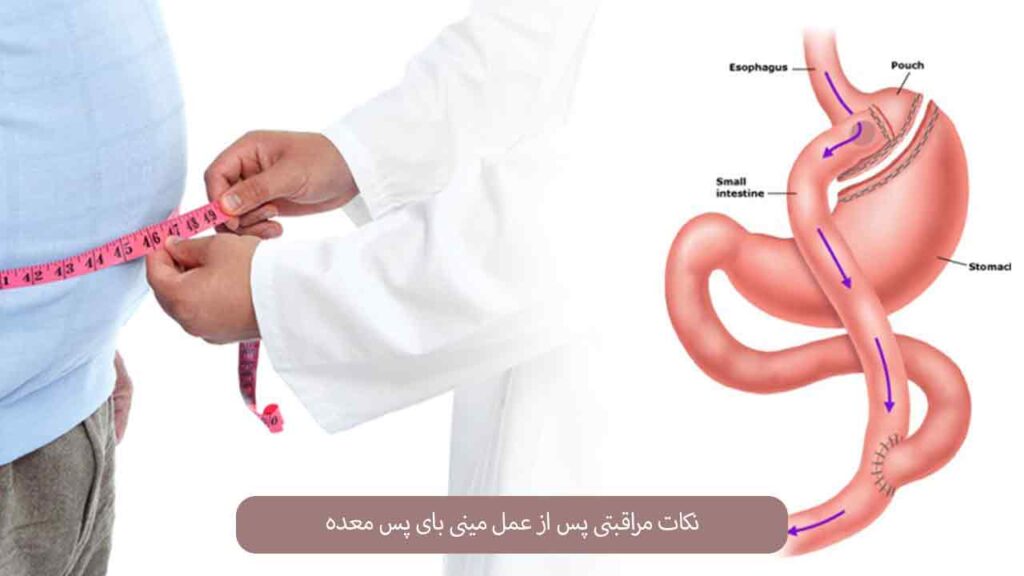 نکات مراقبتی پس از عمل مینی بای پس معده