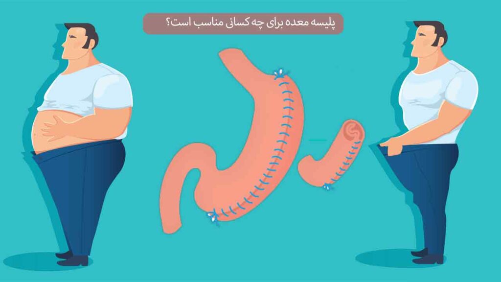 پلیسه معده برای چه کسانی مناسب است؟