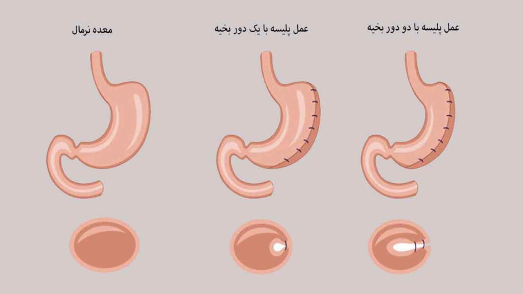 پلیسه معده چیست؟