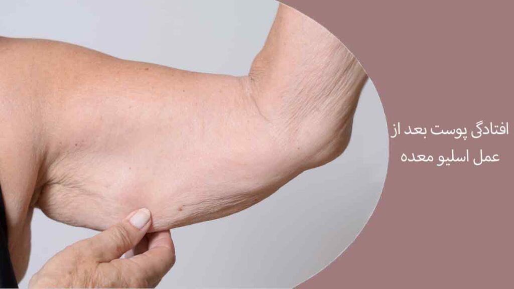 افتادگی پوست بعد از عمل اسلیو معده