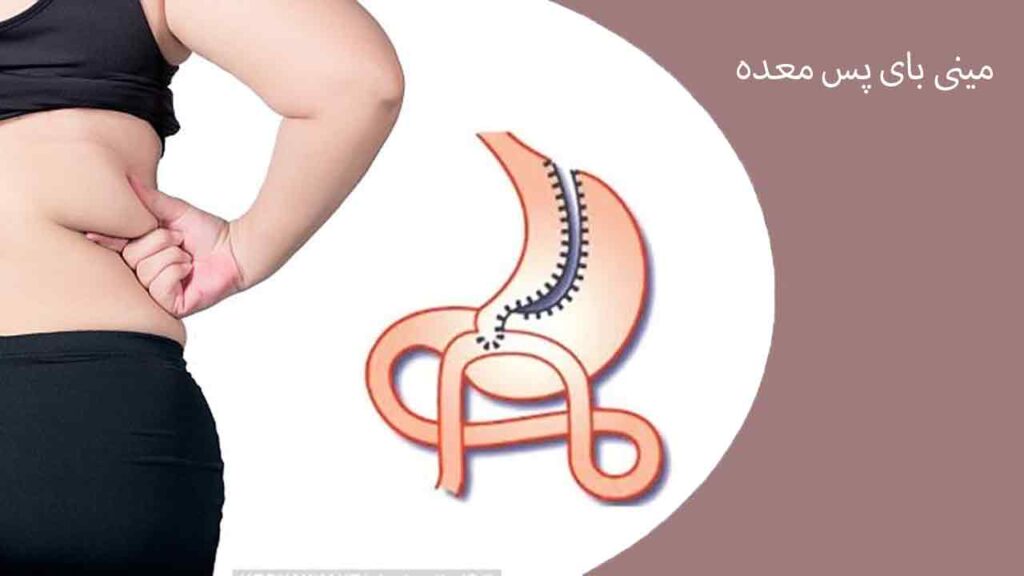 مینی بای پس معده