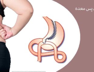 مینی بای پس معده